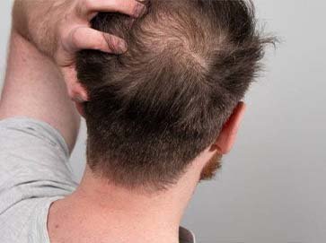 HAIR LOSS TREATMENTS